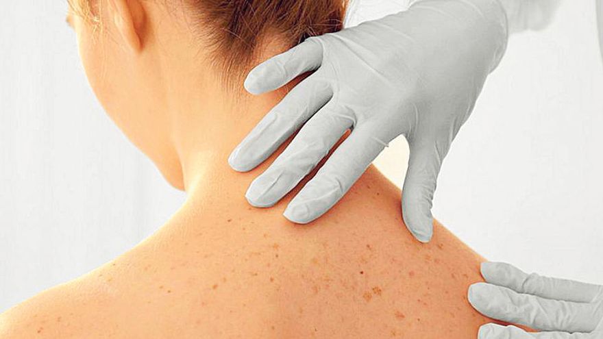 Cáncer de piel: señales que te avisan de que puedes tenerlo