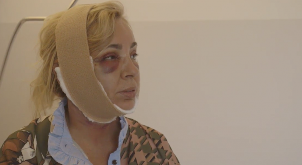 Segundo retoque que se realizó Carmen Borrego