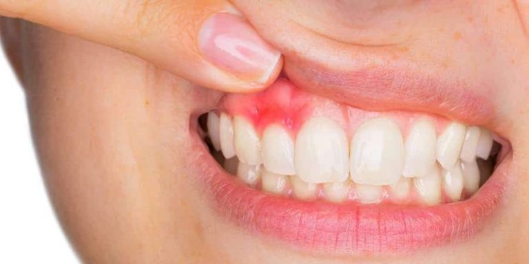 Cómo tratar las encías inflamadas
