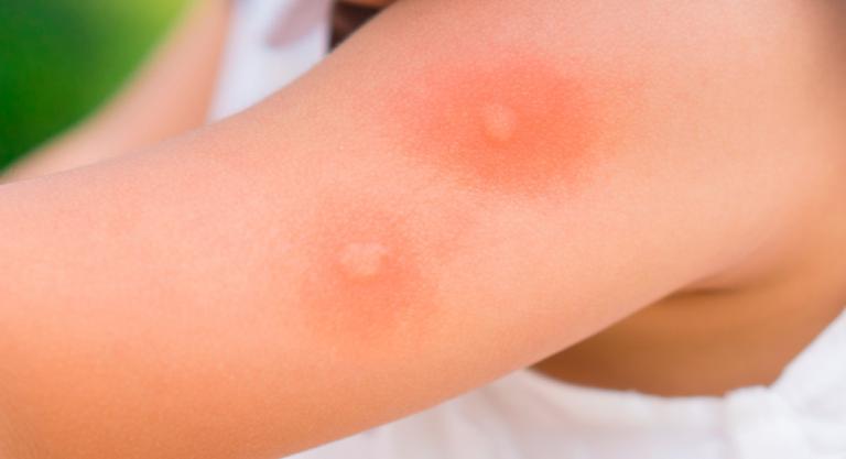 Mosquito, avispa o abeja: fotos que identifican las picaduras de insectos