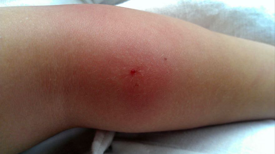 Hinchazón roja y crecimiento del tamaño de la inflación luego de ser picado por el mosquito