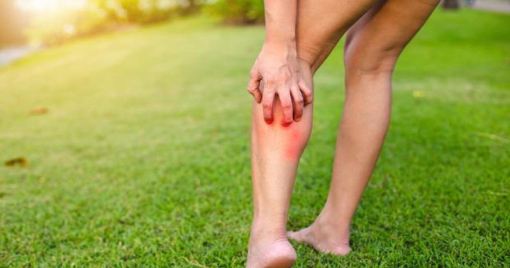 Picazón muy dolorosa, tras la picadura del mosquito