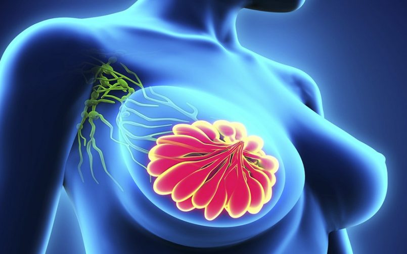 Qué es el ganglio centinela