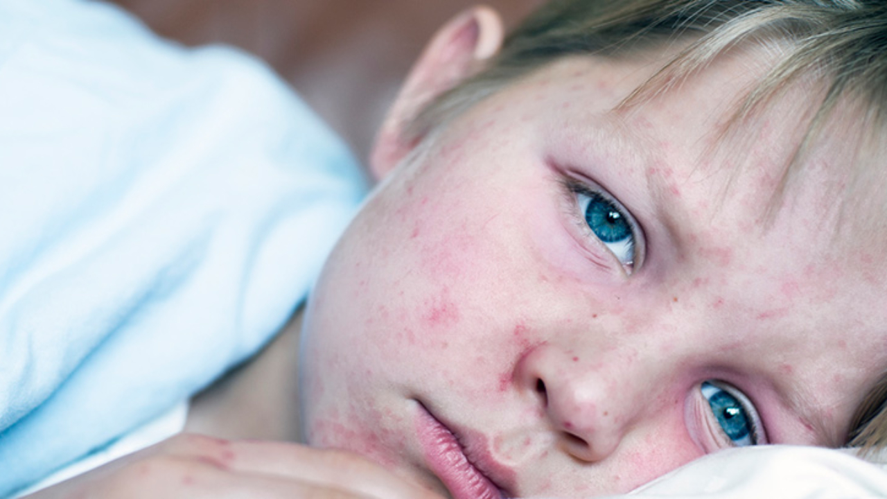 Qué es el sarampión 1 Qué es el sarampión