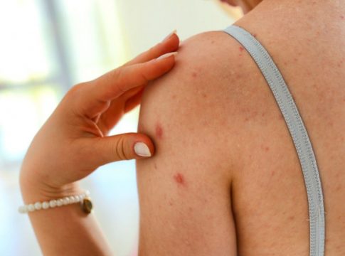 Qué es el sarampión Qué es el sarampión