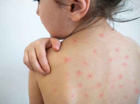 Qué es el sarampión Qué es el sarampión