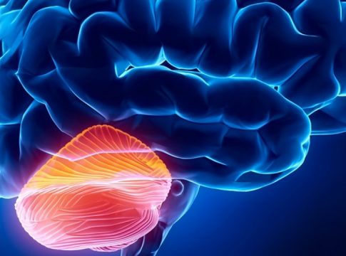 Qué es la ataxia Qué es la ataxia