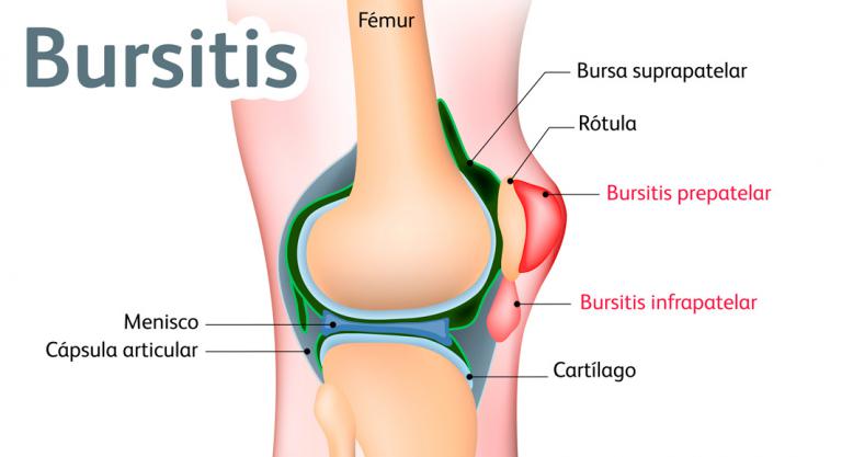 Qué es la bursitis