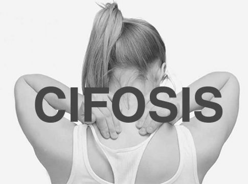 Qué es la cifosis Qué es la cifosis