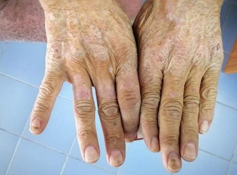 Qué es la esclerodermia Qué es la esclerodermia