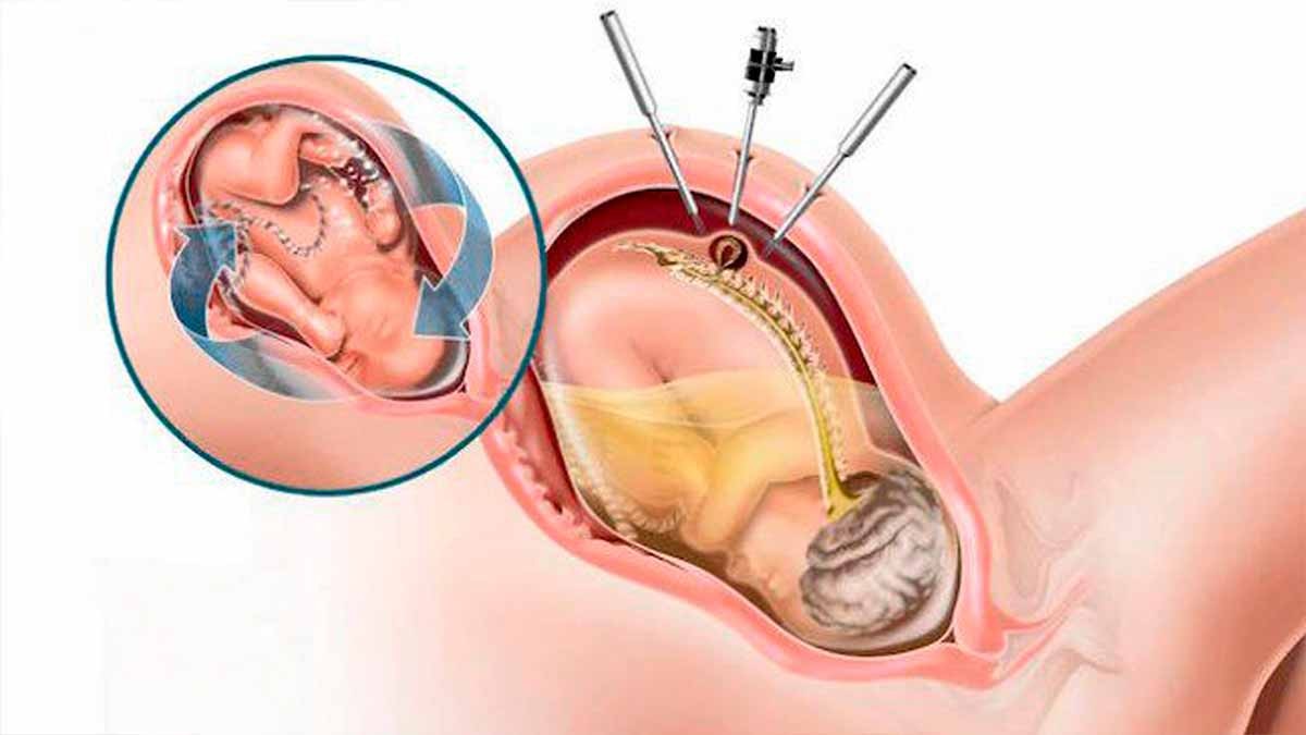 Qué es la espalda bífida