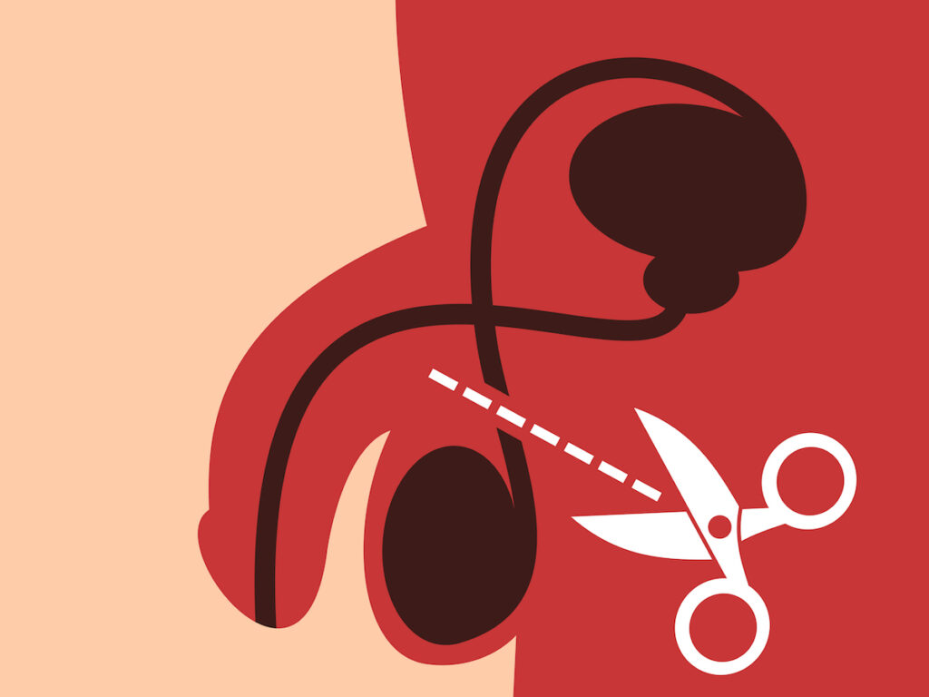 Qué es la vasectomía