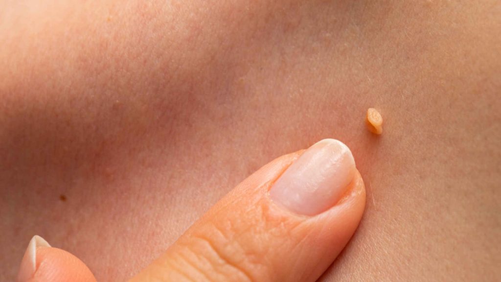 Un producto antiverrugas