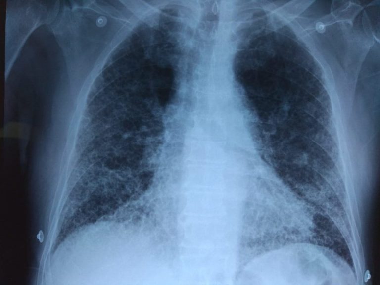 Novedosos enfoques terapéuticos contra la fibrosis del hígado, según un reciente estudio