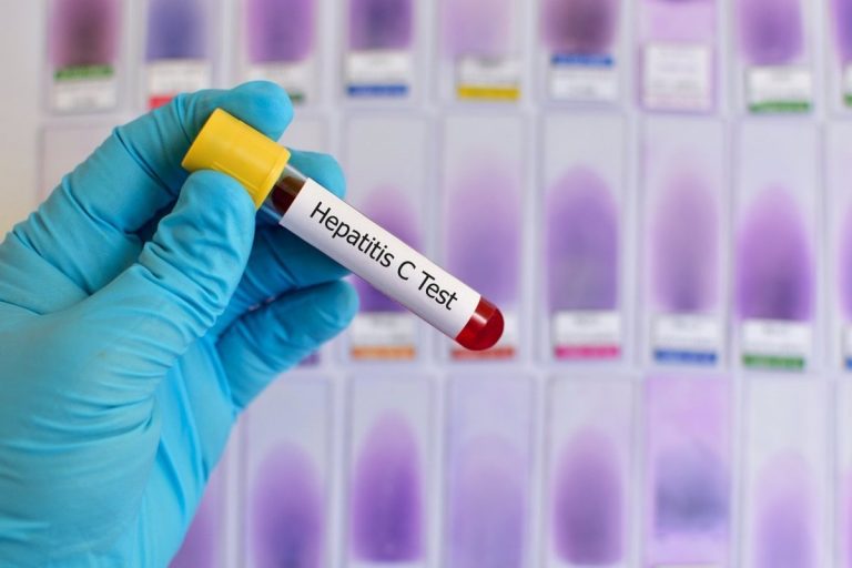 La generalización de los antivirales orales reducen complicaciones de la hepatitis C