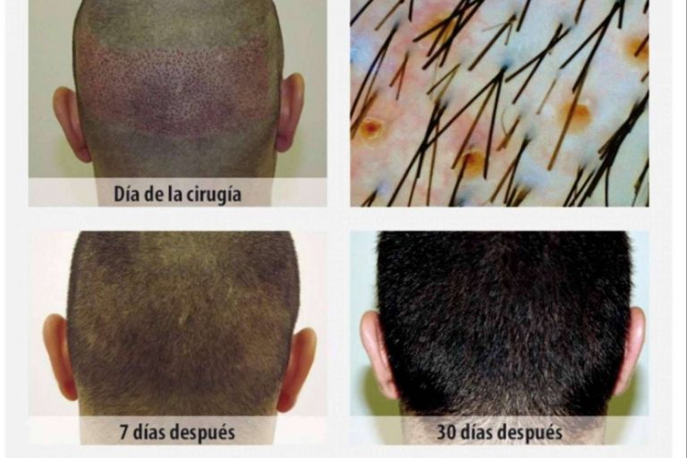 ¿Cuál es la mejor clínica de injerto capilar en Sevilla?