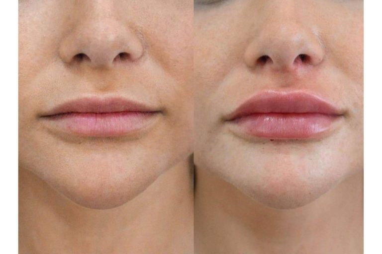 Tratamiento de ácido hialurónico de la mano de uno de los especialistas con más renombre del país, el Dr. Castellar