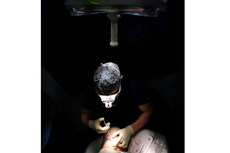 Los cuidados generales del trasplante capilar en verano