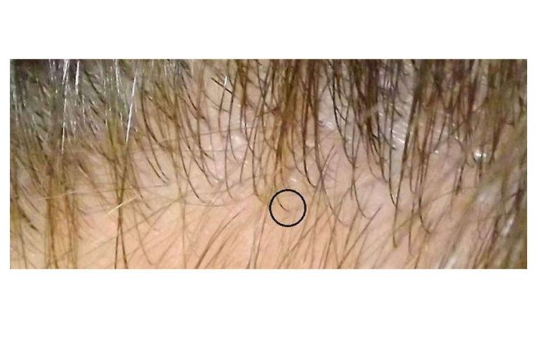 centro recomendado para obtener los mejores resultados de trasplante capilar en España