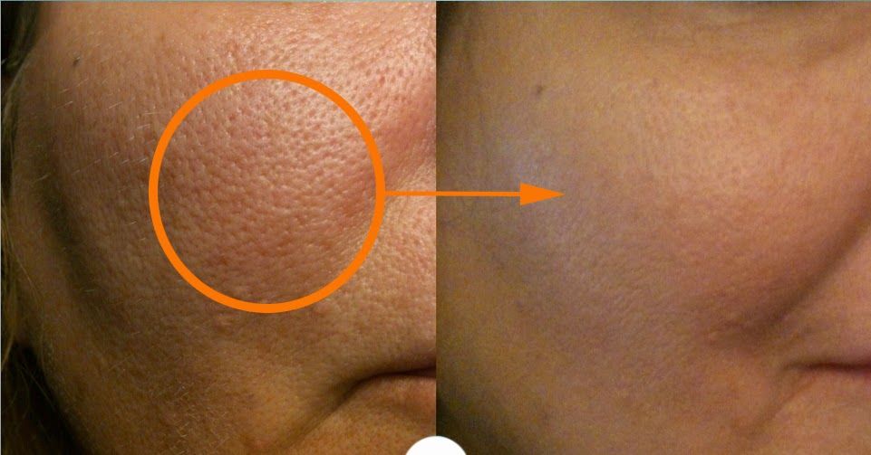 Puntos a tomar en cuenta antes de aplicar cualquier producto para controlar los poros de la cara