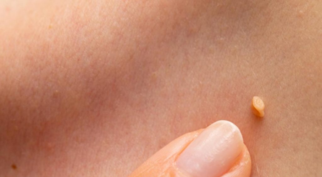 ¿Qué tan peligrosas son las verrugas?