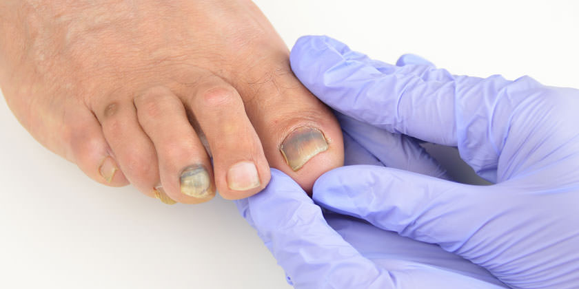 Cómo tratar las uñas moradas 99 Tratamientos