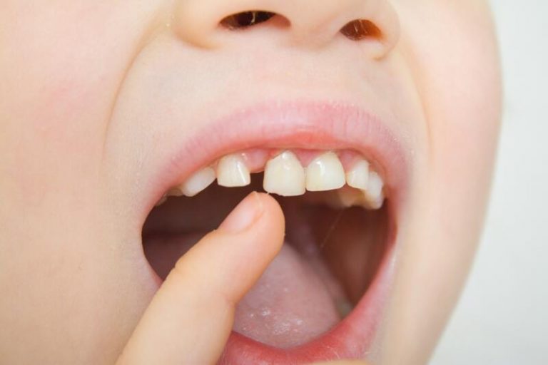El 46% de los padres piensa que sus hijos no tienen ningún problema bucodental