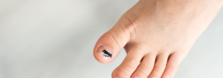 Cómo tratar las uñas moradas 100 No hay tratamientos especiales, pero se debe prevenir la aparición de uñas moradas