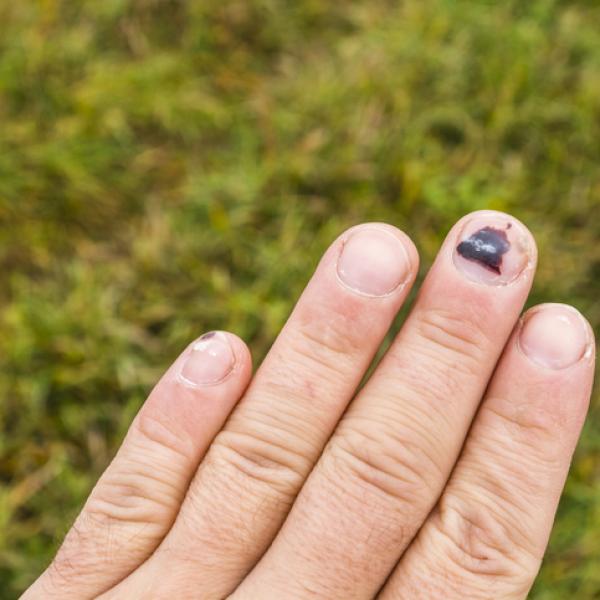 Cómo tratar las uñas moradas 98 ¿Qué ocasiona la aparición de uñas moradas?