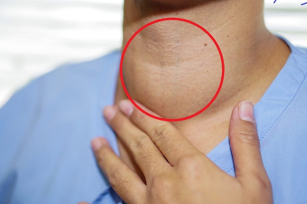 ¿Qué síntomas tiene el cáncer de tiroides? 1 Bulto en el cuello