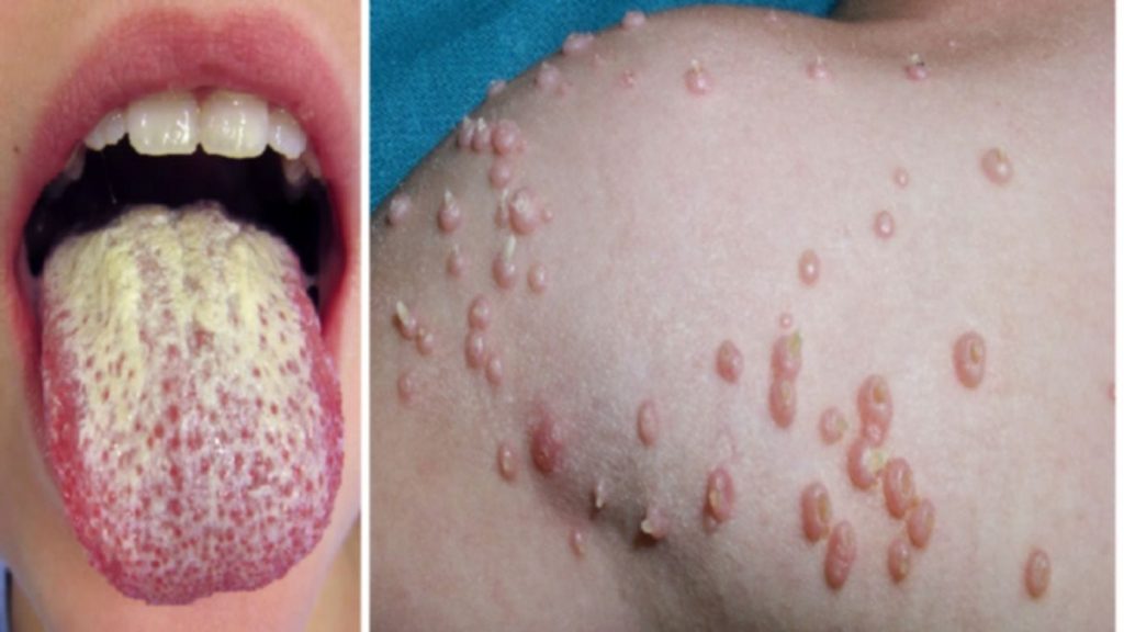 ¿Cuáles son las consecuencias de sufrir de Clamidia?