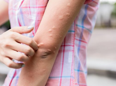 Como-protegerte-del-mosquito-que-transmite-la-fiebre-del-Nilo-12