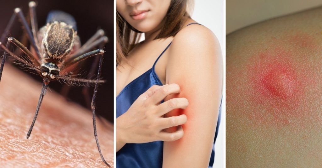 ¿Qué se debe hacer en caso de que pique un mosquito?