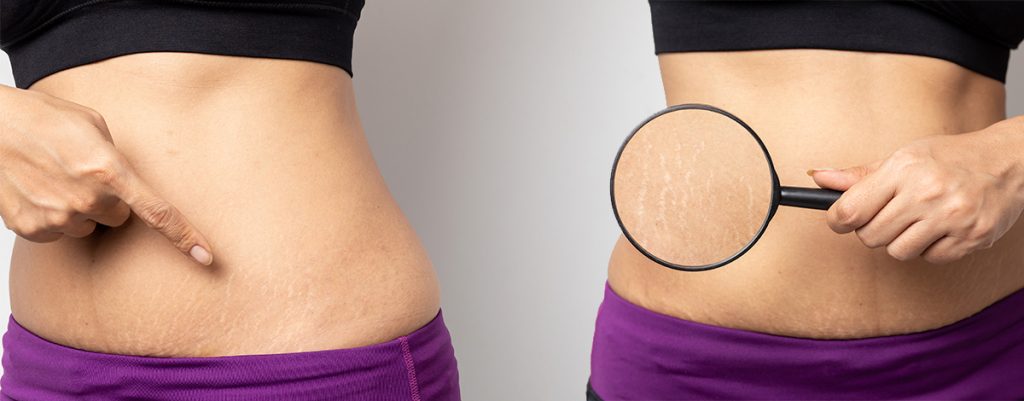 El truco para tratar las estrías y hacerlas desaparecer 54 ¿Cuáles son las causas del estrías?