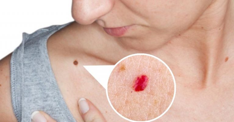 Lunares rojos: ¿qué son y por qué te aparecen?