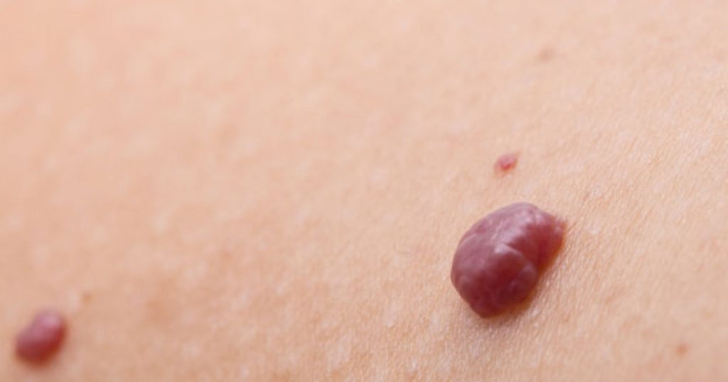 ¿Cuáles son algunas de las características de los Lunares rojos?