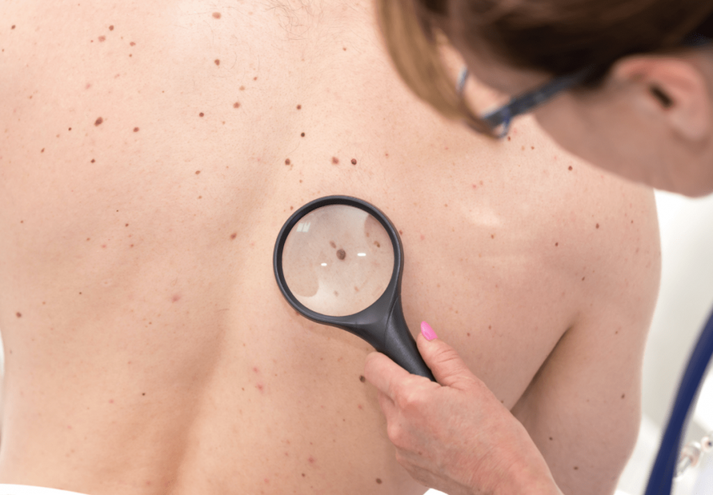 ¿Los Lunares rojos se trasforman en cáncer de piel?