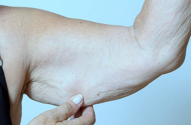 Qué es la sarcopenia