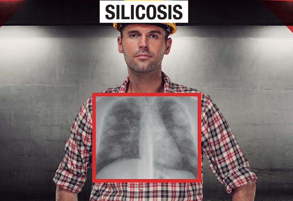 Qué es la silicosis