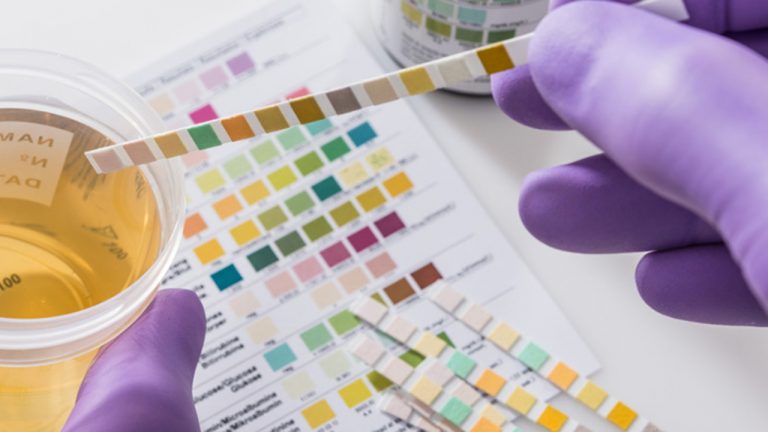 Qué es un sedimento de orina