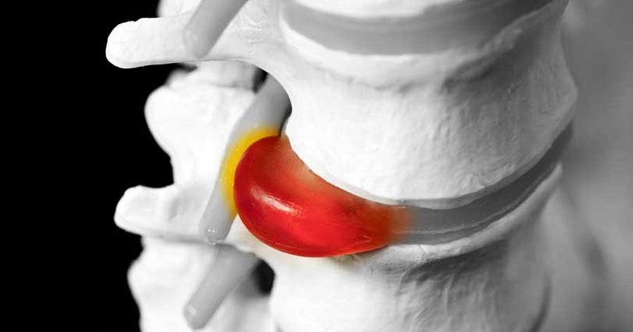 Qué es una protusión discal