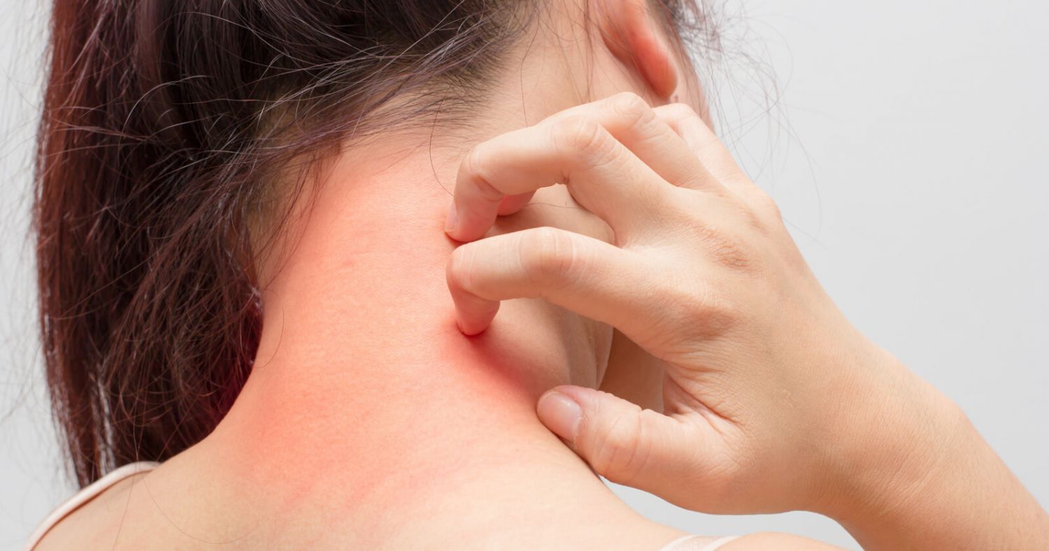 Qué son los forúnculos 101 Qué son los forúnculos