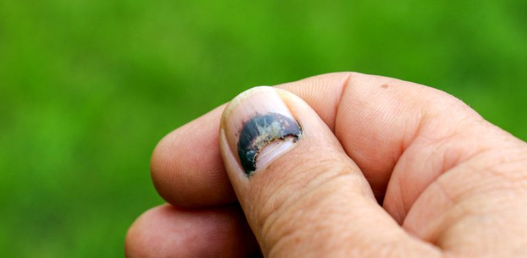 Cómo tratar las uñas moradas