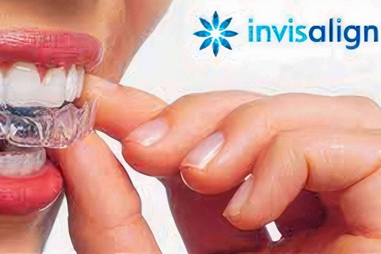 La técnica Invisaling en Valencia no deja de ganar popularidad