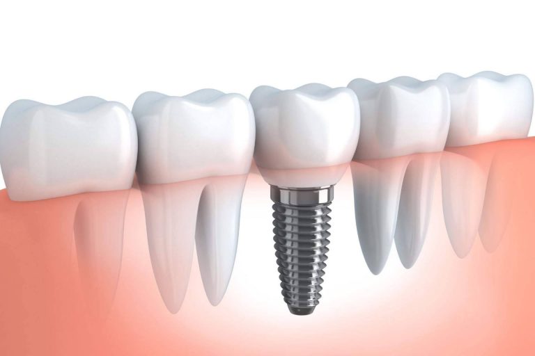 ¿Qué son los implantes de carga inmediata de Implant Clinics?