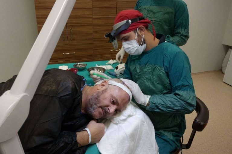 Injerto capilar Turquía todo incluido: FUE Hair Transplant System