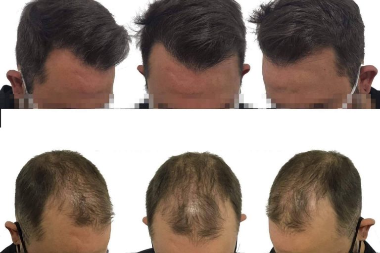 ¿Cuáles son las técnicas más recomendadas por el especializado Dr Bruno Jacobovski?: Injerto o trasplante capilar