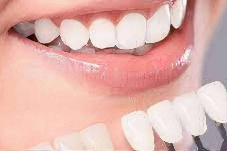 Implant Clinics ofrece el blanqueamiento dental de calidad para tener la mejor sonrisa