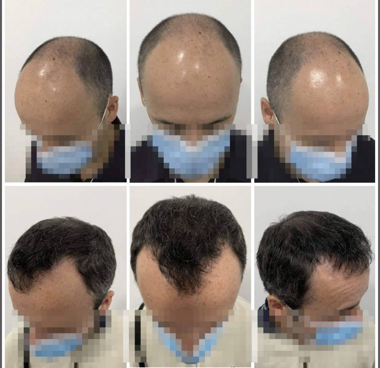 ¿Dónde realizarse el injerto capilar más natural y denso en Barcelona?: Dr. Bruno Jacobovski