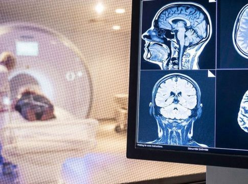 lesiones cerebrales covid